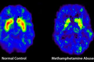 Brain Scan of meth addict